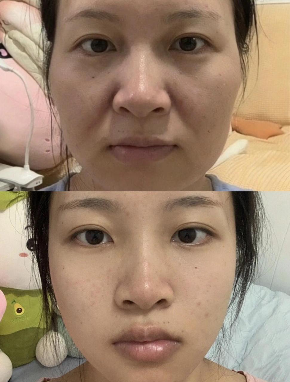 83年的,脸上砸了一个包的钱,值吗?  就想漂亮一点,现在看起来还老吗?