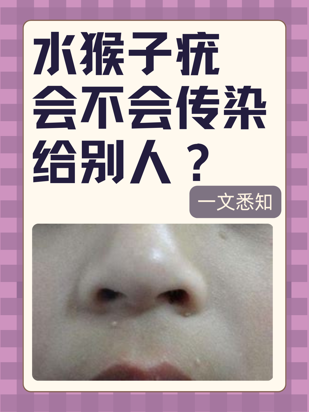 小朋友脸上,胸口有几个小小的圆形丘疹,看起来像绿豆那么大,而且还有