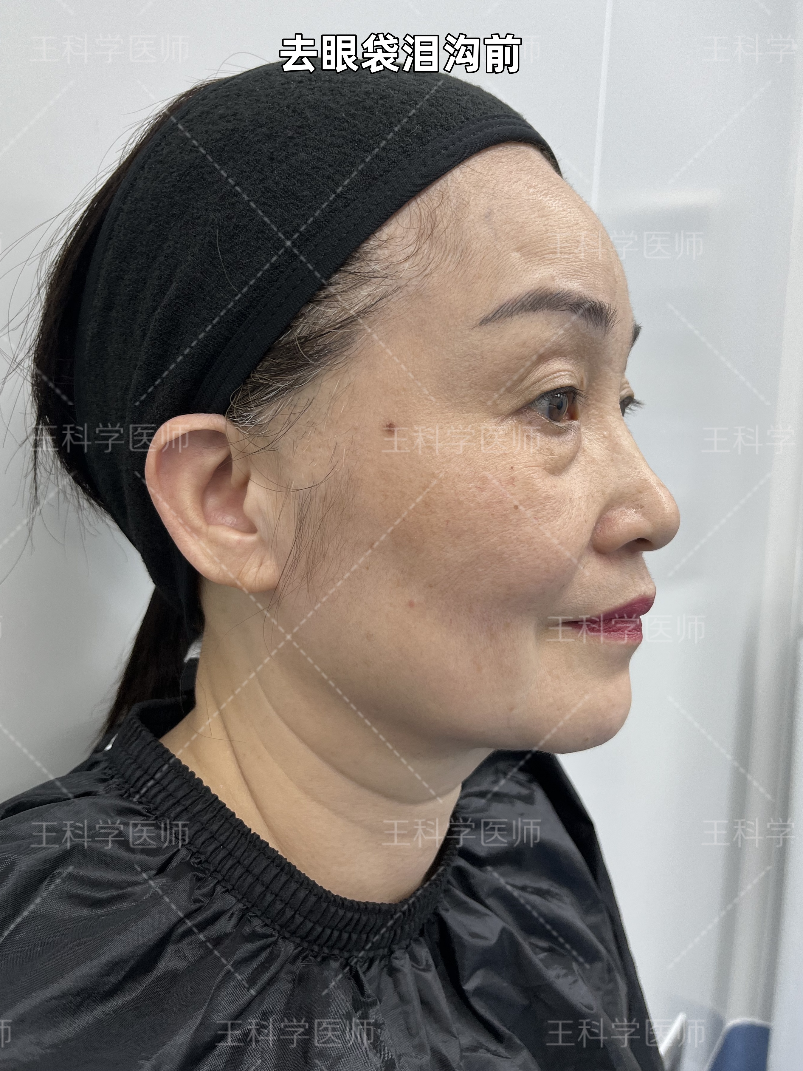 术后随访案例:求美者58岁,术前眼袋比较严重,有泪沟,苹果肌下垂,有