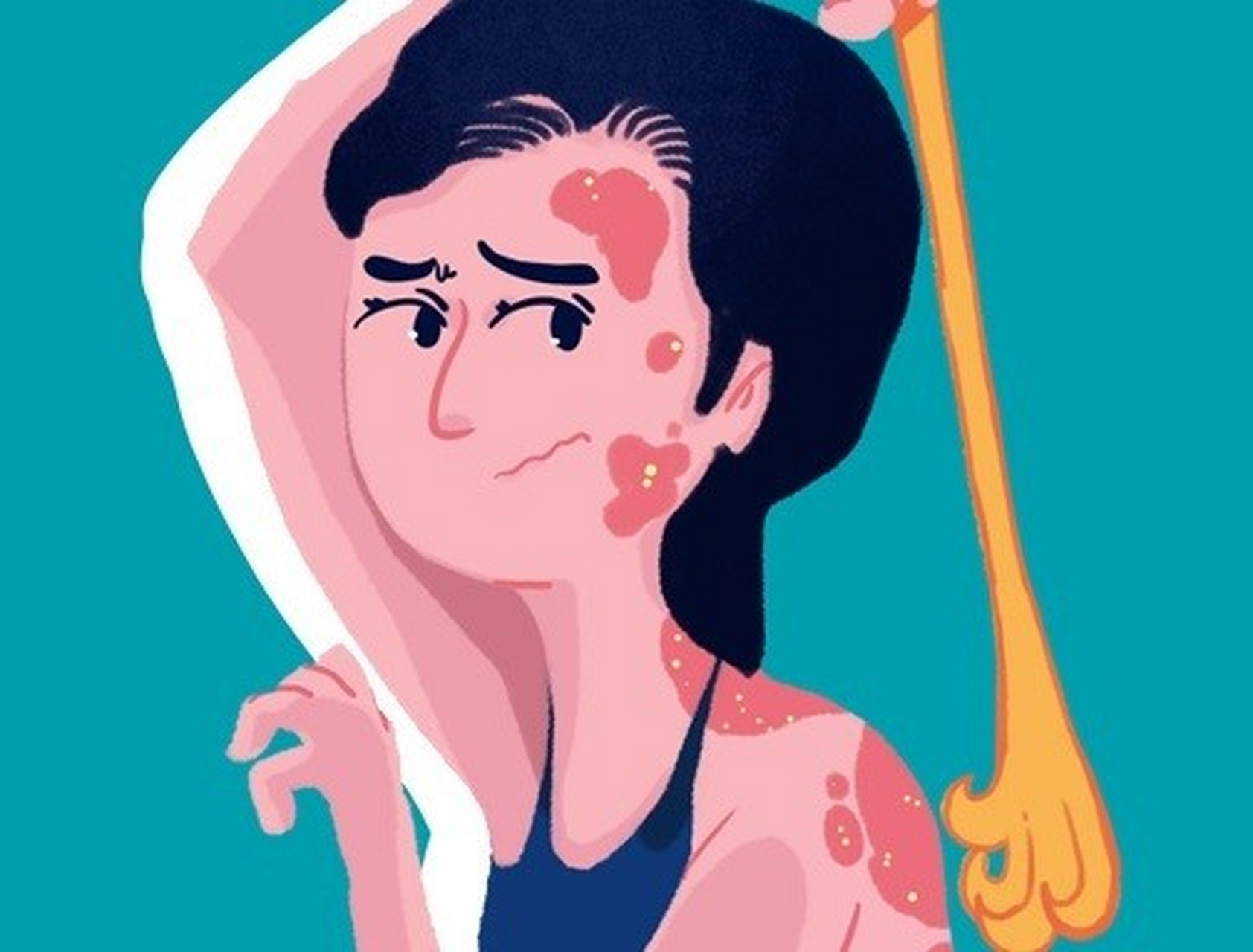 在夏季,牛皮癣患者应注意以下事项:#牛皮癣# #银屑病# #牛皮癣科普