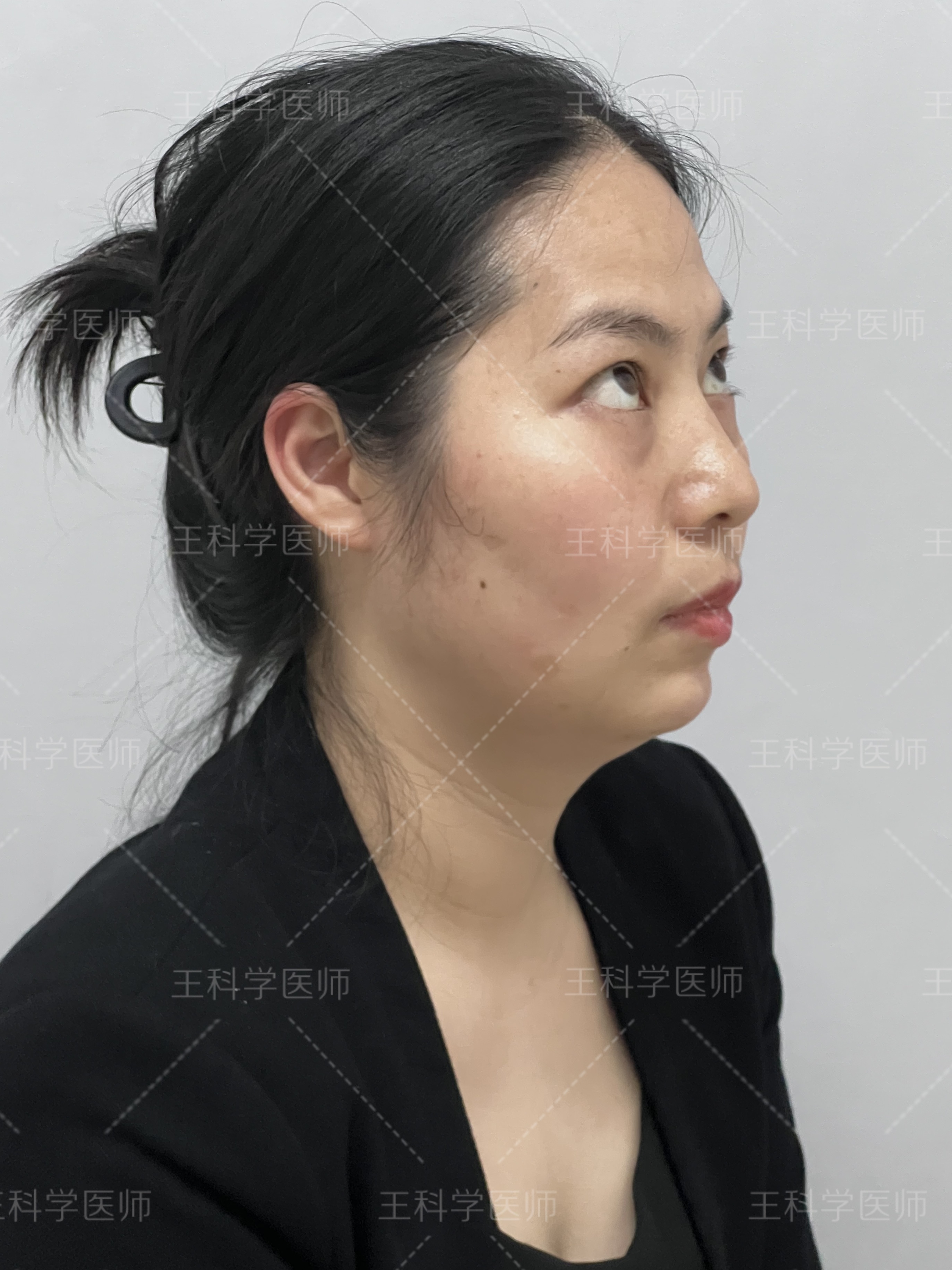 38岁偷偷做了眼袋手术,刚过恢复期,我来说几件过来人才懂的事