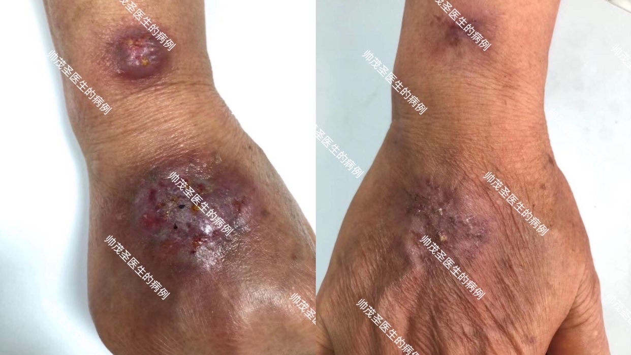 不慎被鱼虾等水产品刺伤,小心海鱼分枝杆菌