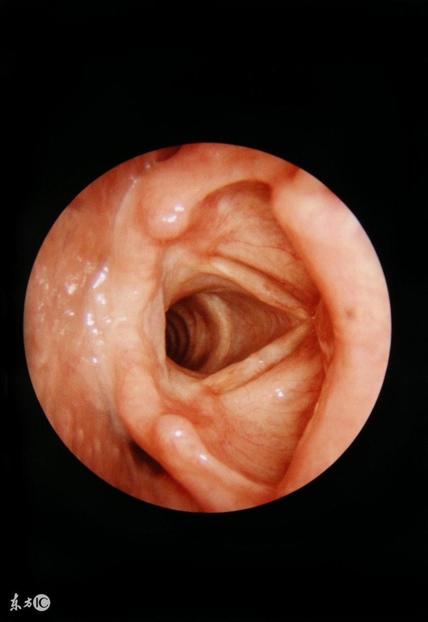 声音嘶哑警惕早期喉癌可能
