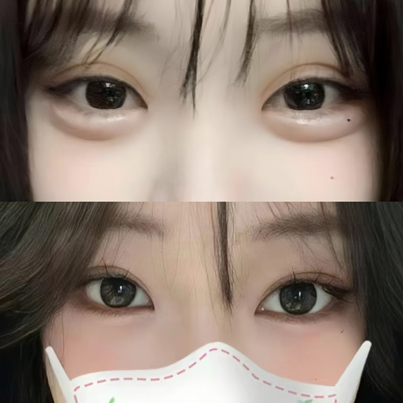 该求美者第一次做双眼皮选择了10mm的宽度,这种欧式平行双眼皮和