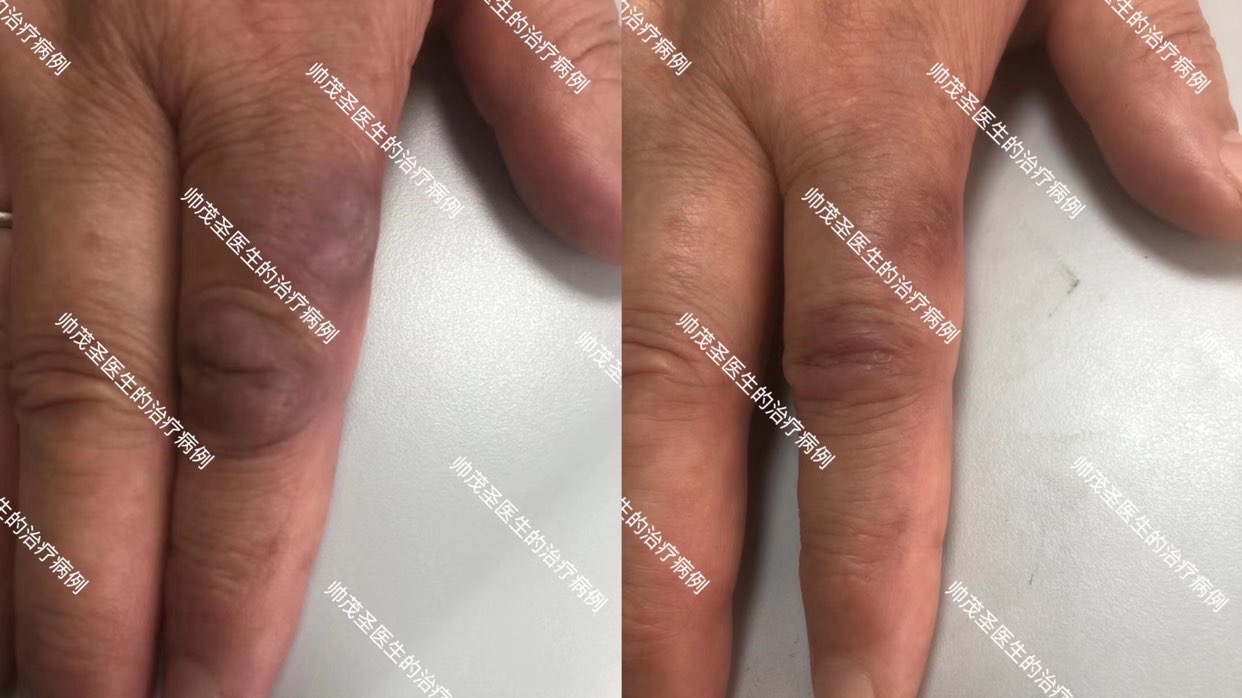 不慎被鱼虾等水产品刺伤,小心海鱼分枝杆菌