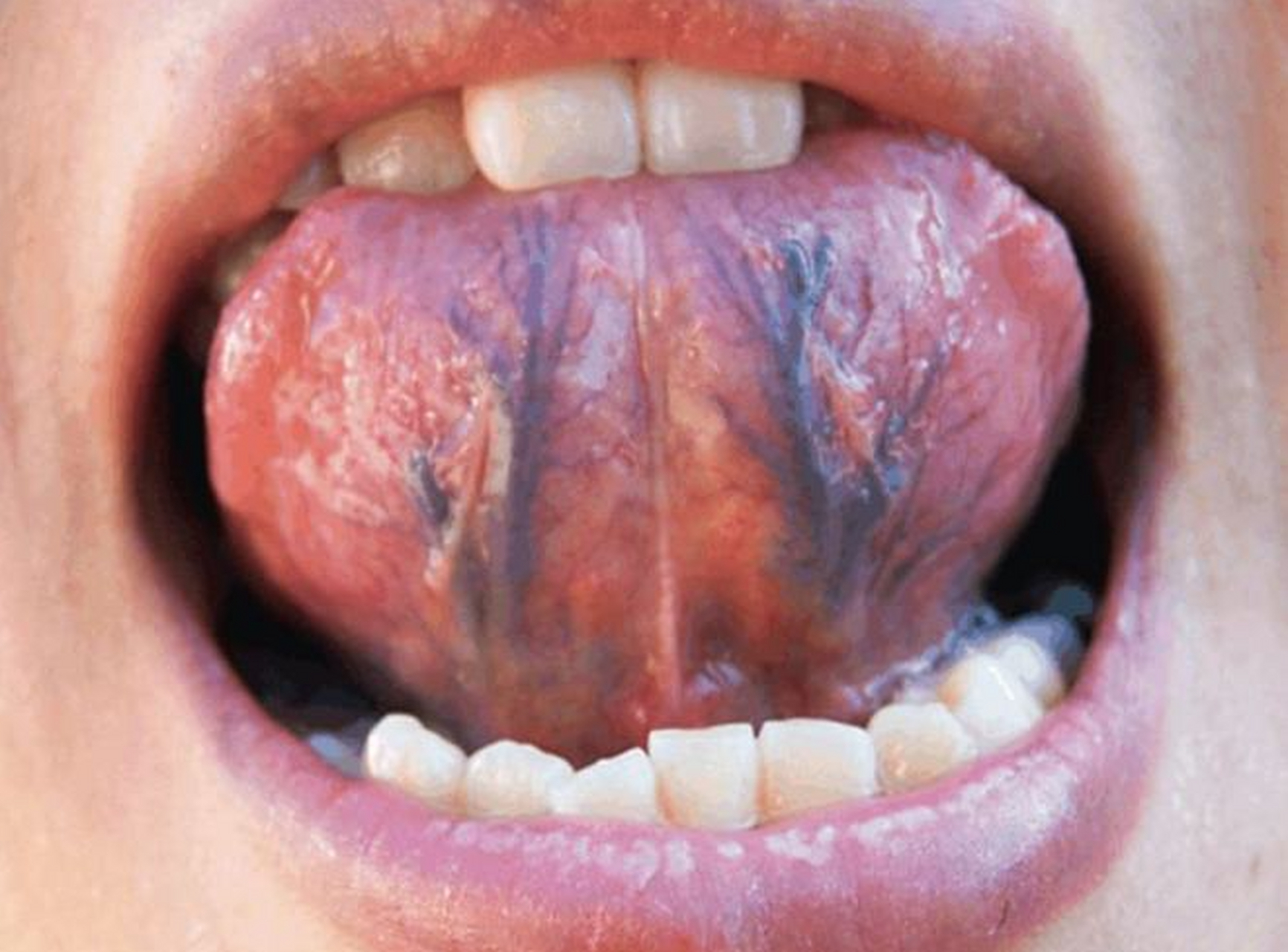 1分钟自测是否肝郁血瘀 健康舌底:清爽干净,两根舌底静脉血管直径不