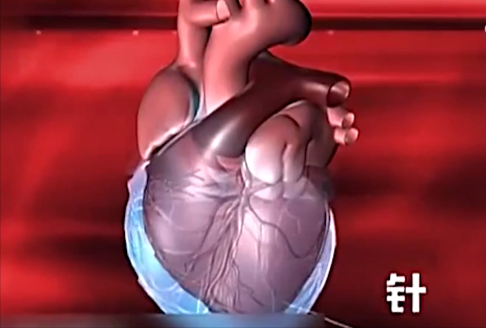 心脏已被扎的"千疮百孔",准备手术!