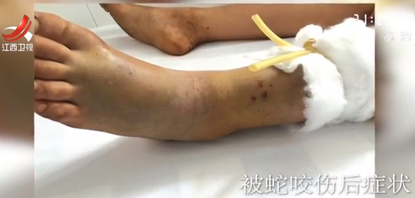 18年,陕西21岁女孩网购毒蛇被咬,抢救6天后死亡,母亲索赔140万