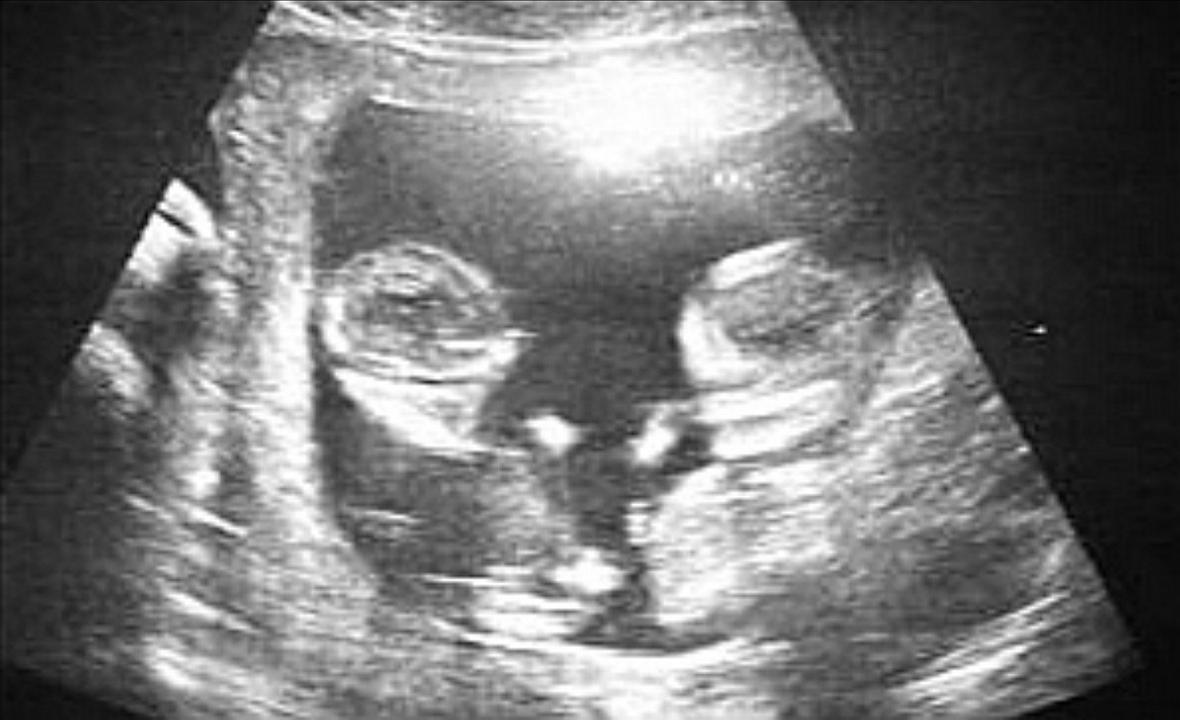 2006年,辽宁烈士51岁母亲搏命产下双胞胎:为延续19岁儿子的生命