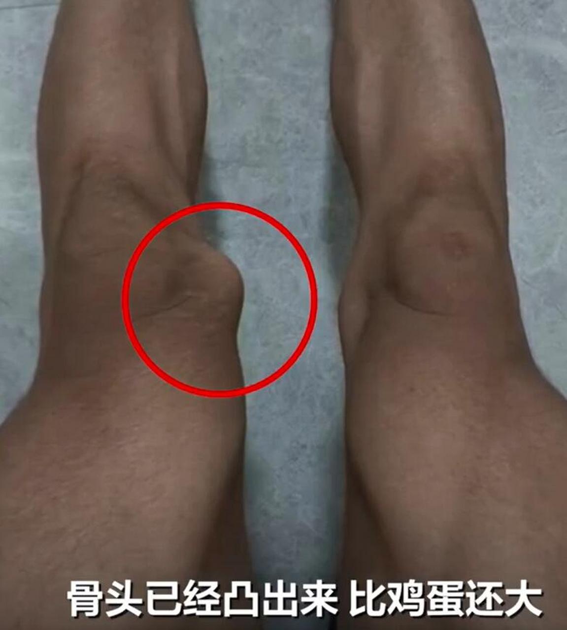 广西17岁男生左膝长骨瘤,被医生误切右膝!