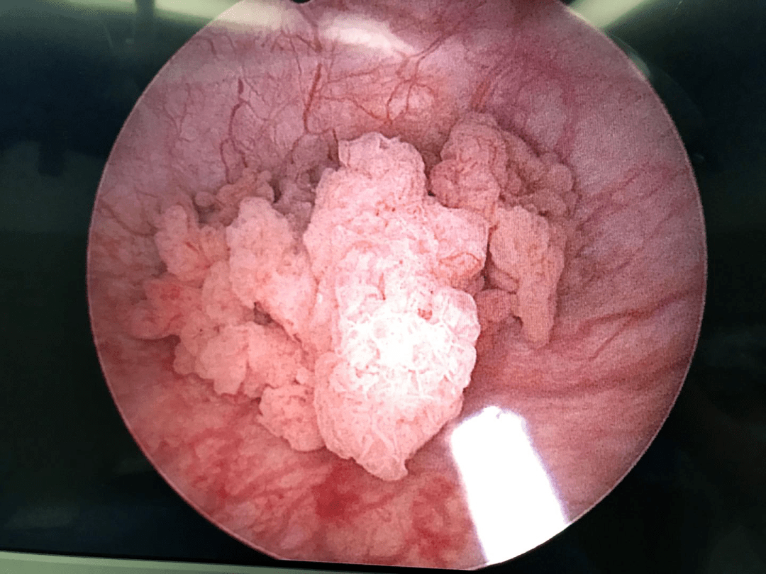 膀胱肿瘤电切术图片