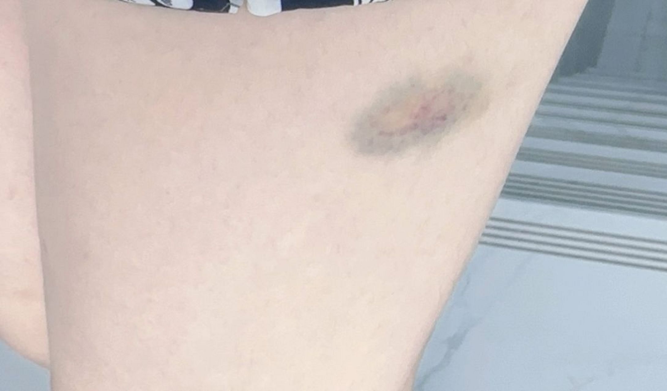 当我撞了个大淤青被蚊子咬了一口后