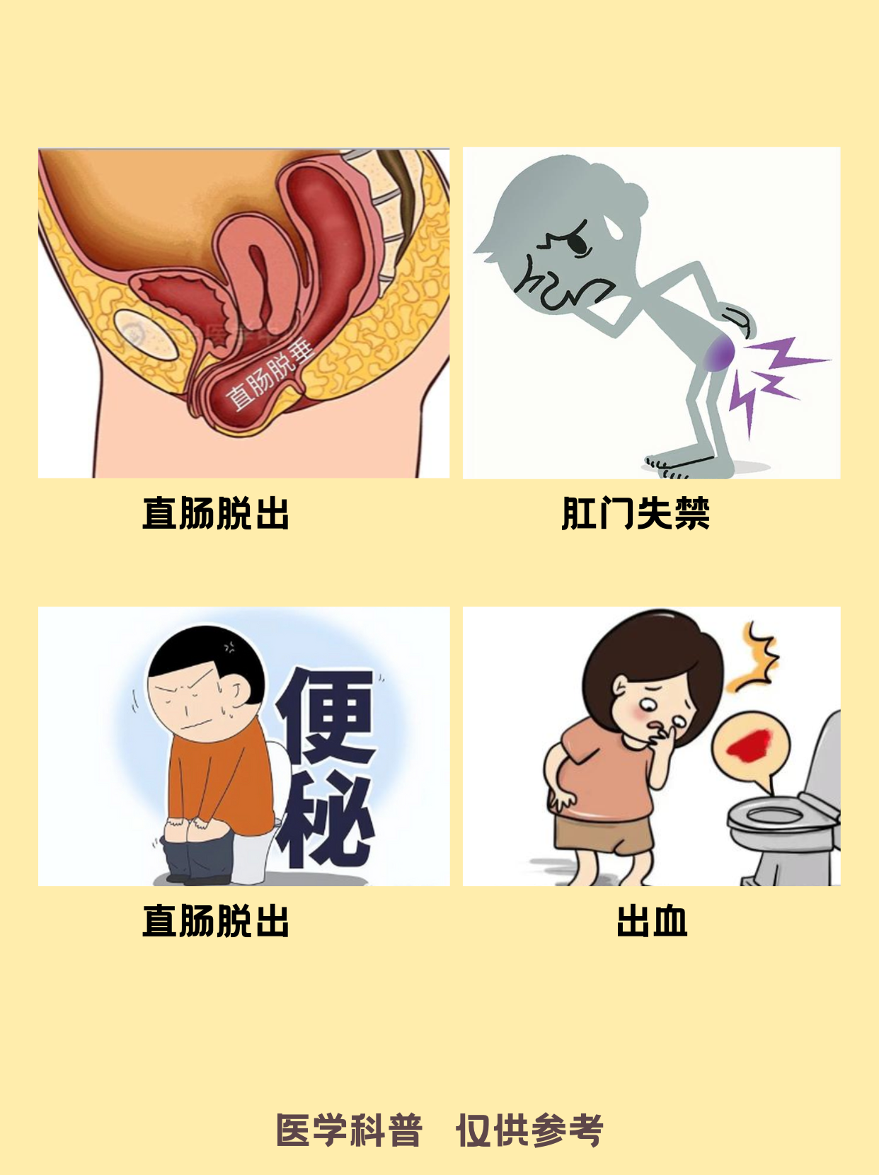 直肠脱垂卡通图片