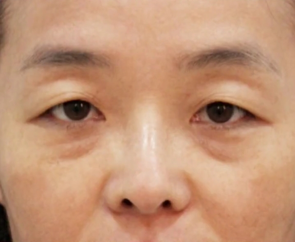 下垂眼周皮肤松泪沟衰老从眼部皮肤猜测年龄眼周衰老眼睛皮肤松弛眼底