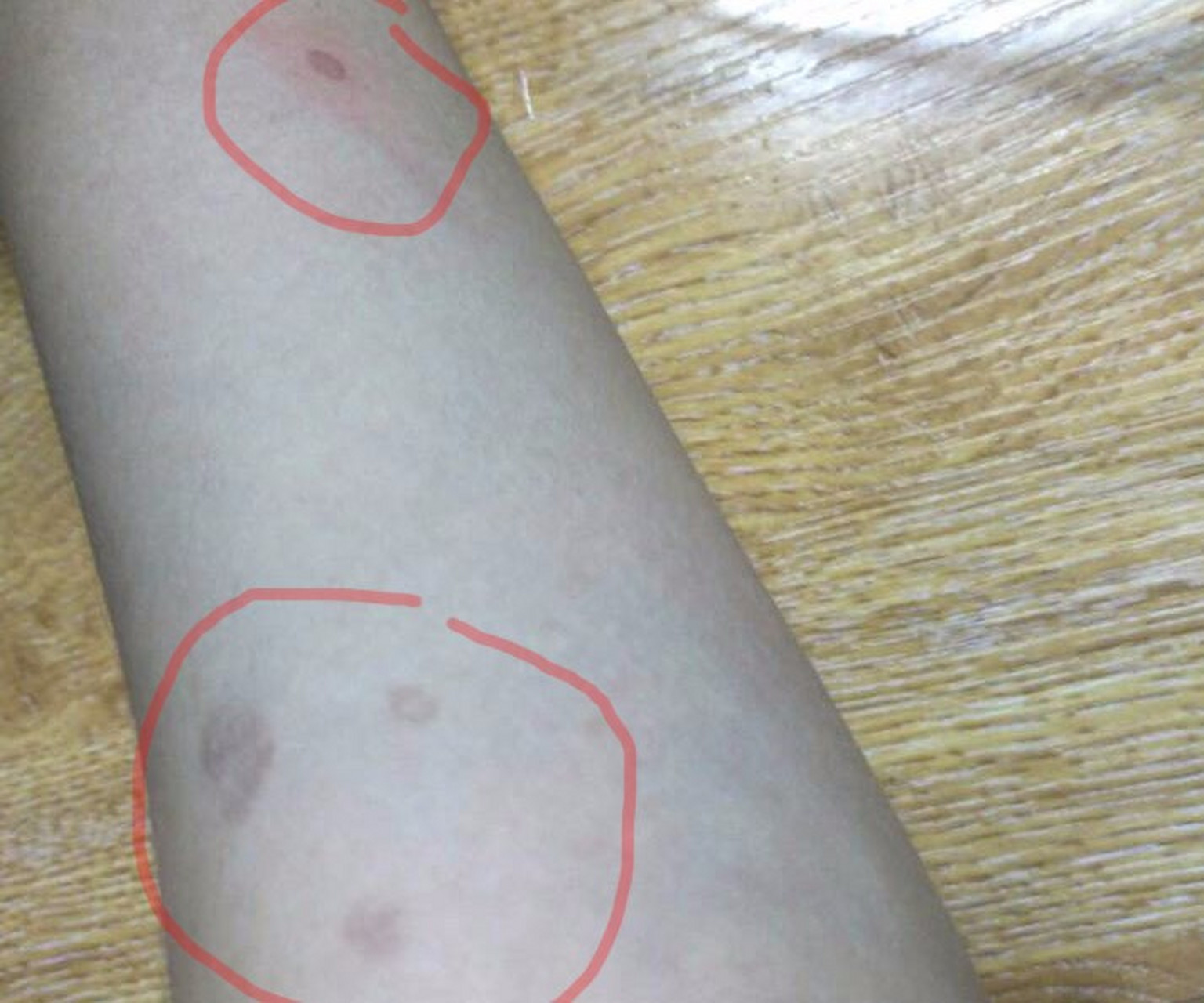 1,是咖啡斑 它的形成跟遗传,环境等因素有关,表现为:边界清楚的色素