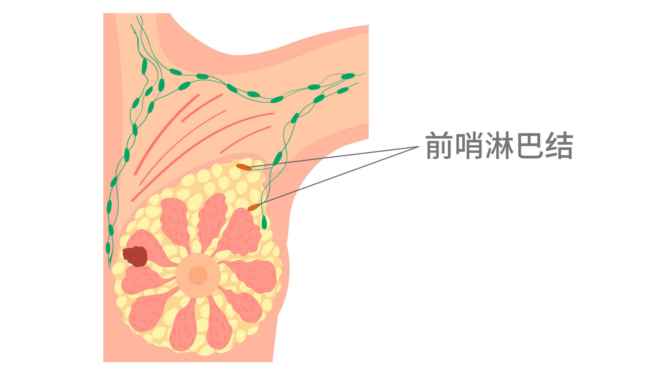 乳腺癌位置图图片