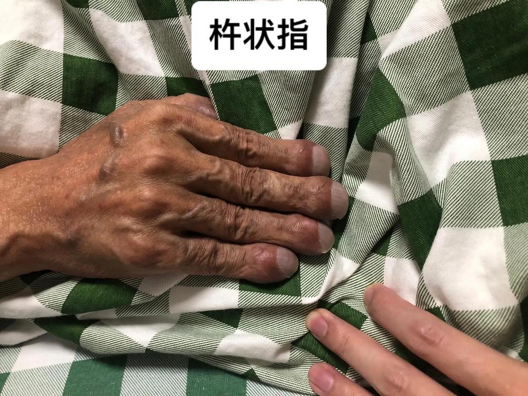 杵状指是肺癌早期的症状,是肺癌最常见的肺外体征,也是慢性缺氧的表现