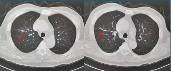 纤维灶 肺部图片