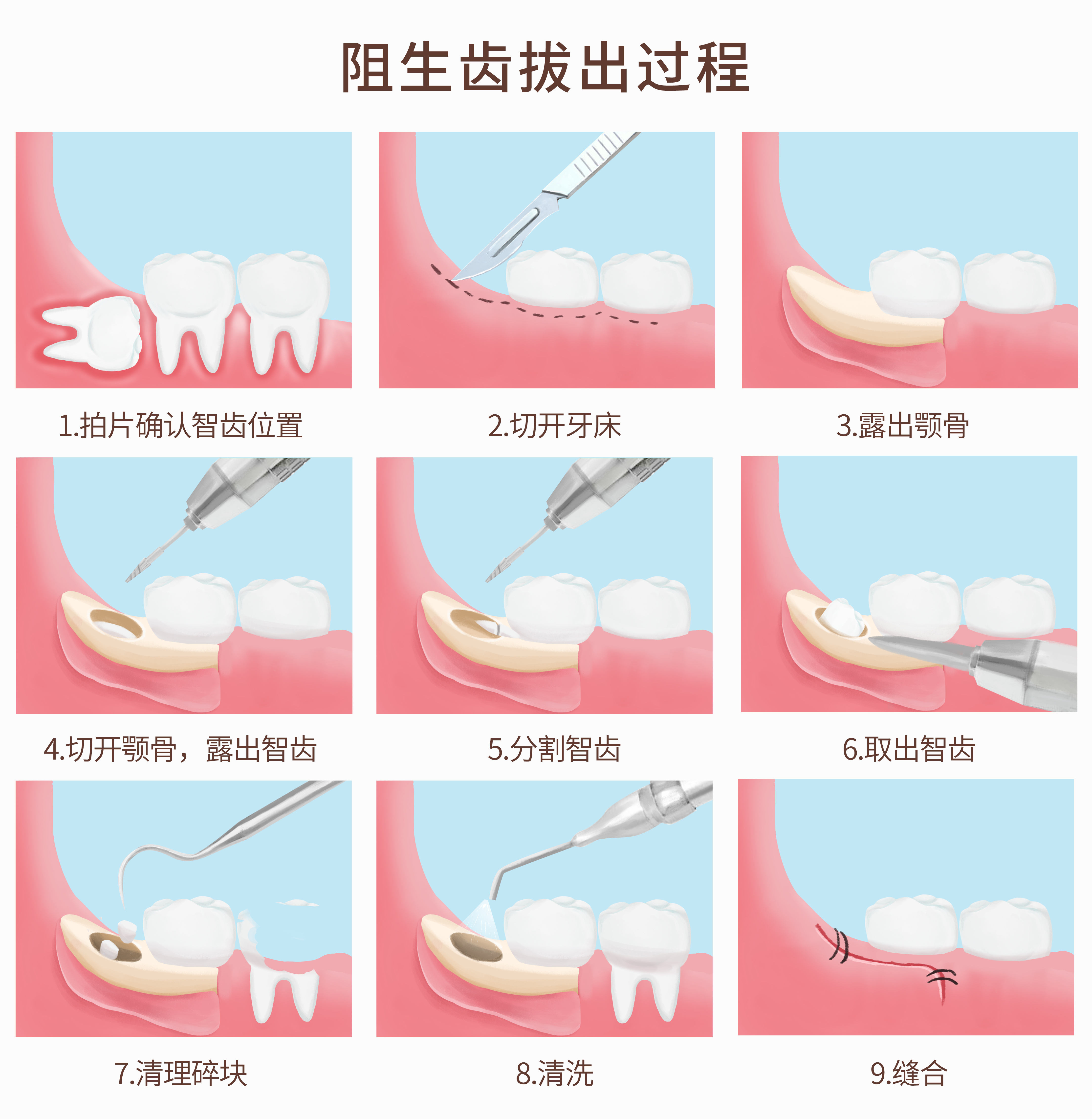 智齿总发炎却不敢拔,最后会怎么样?
