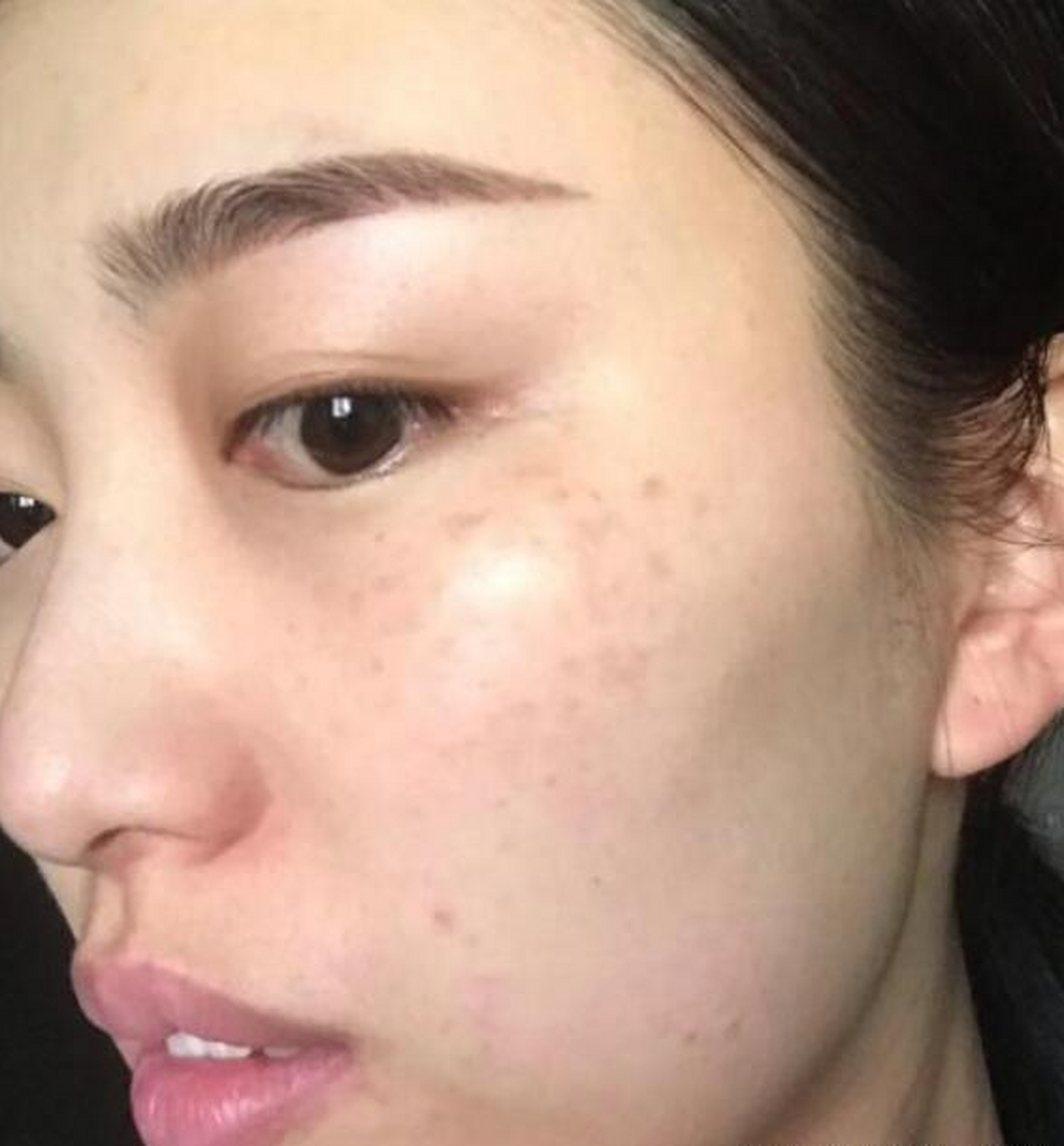 如果你也是这种黄褐斑,恭喜,还有救!  1.面积不大,斑色不是很深  2.