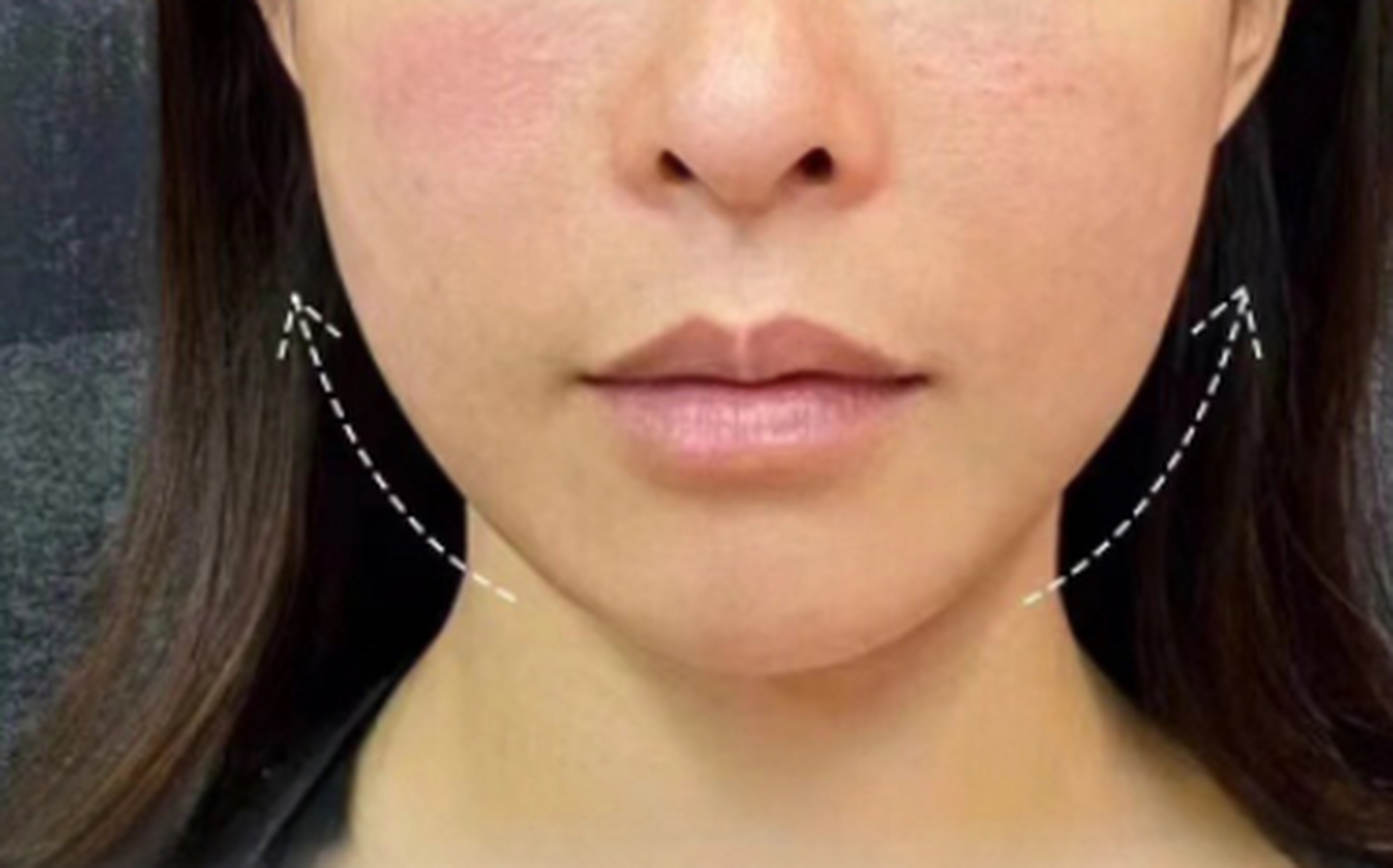 常常伴随颧弓外扩,唇部突出,面部轮廓不流畅等,这就是面颊凹陷