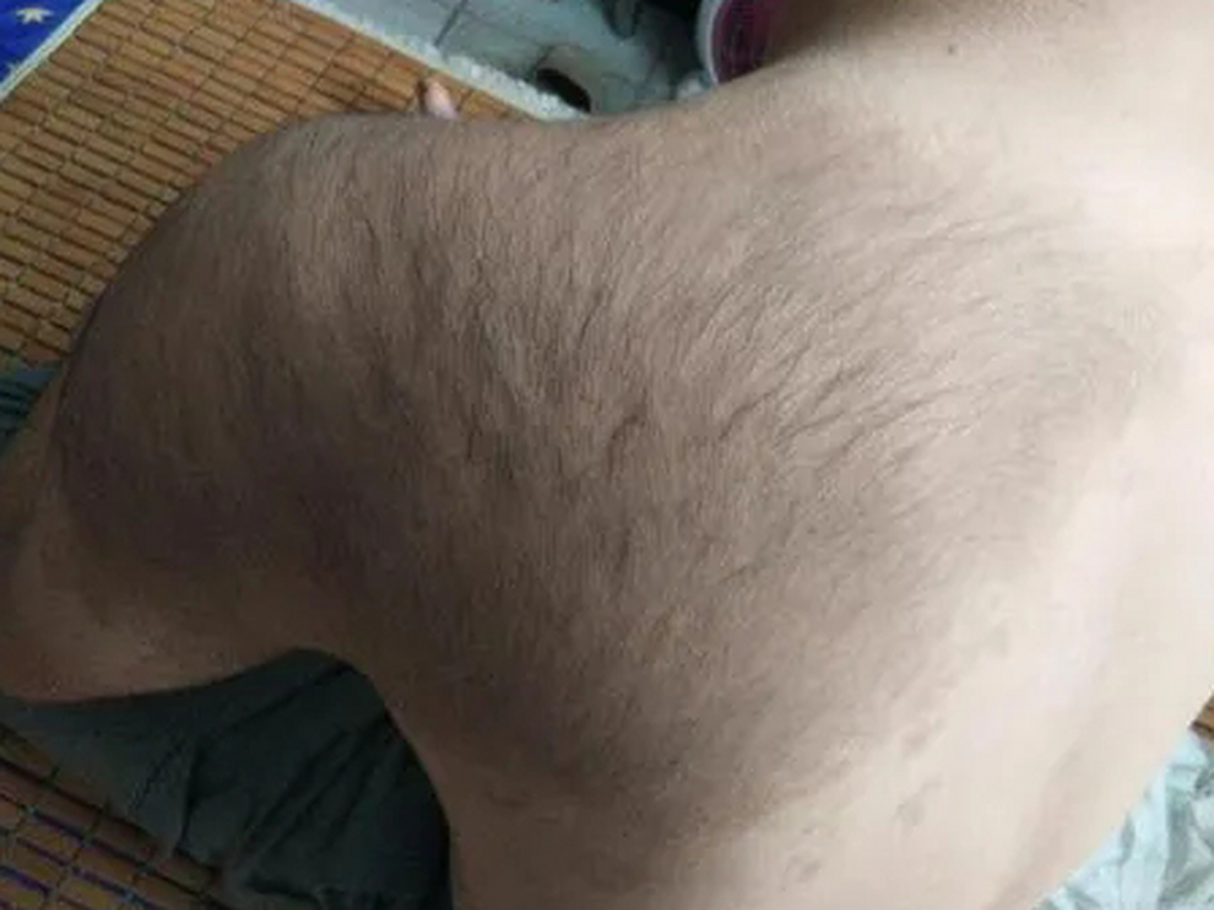 接诊了一个20多岁的小伙子,他是女朋友带来的,后背上有一大块儿胎记