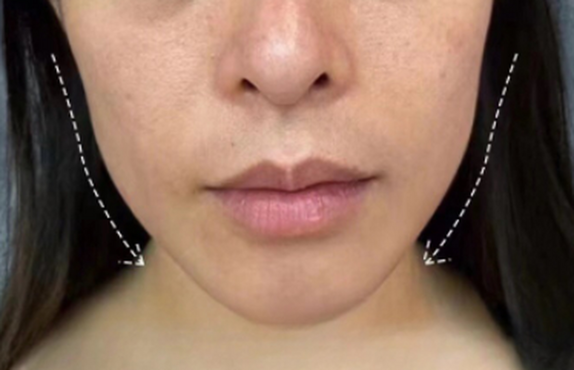 常常伴随颧弓外扩,唇部突出,面部轮廓不流畅等,这就是面颊凹陷