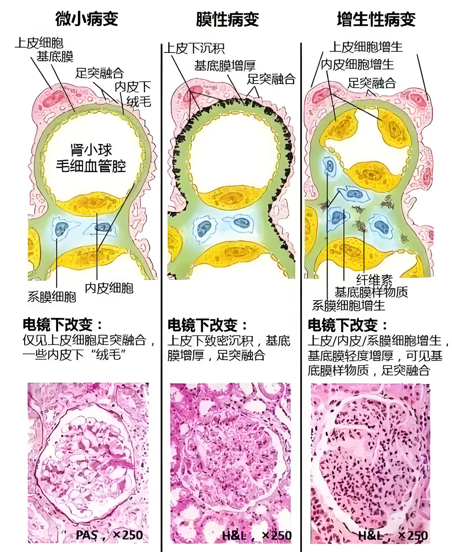 膜性肾病高发