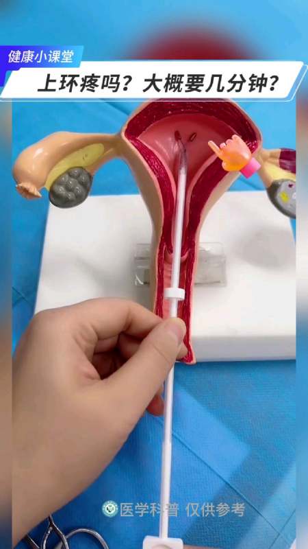 上环疼吗女性上环过程演示