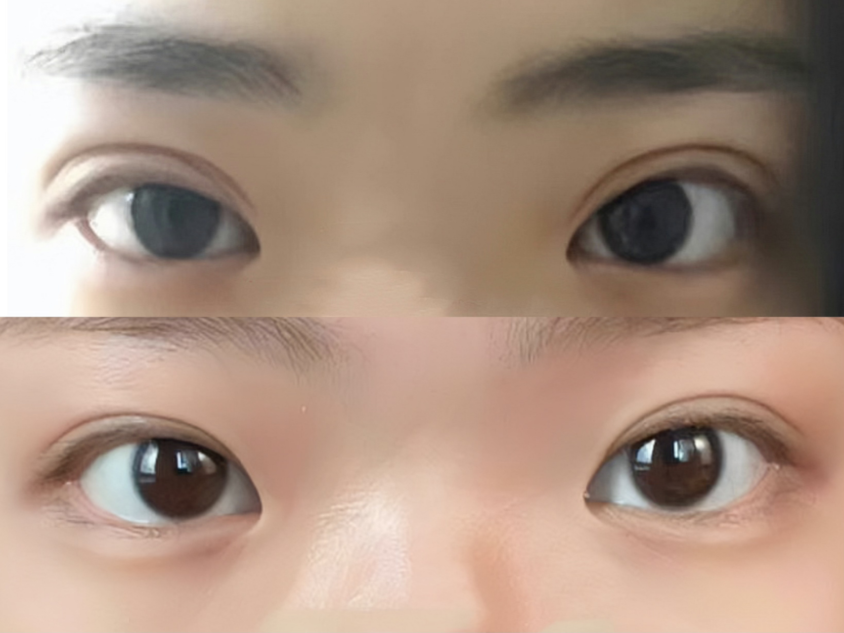 10mm"青蛙眼"双眼皮宽改窄4个月爆改吗生眼!