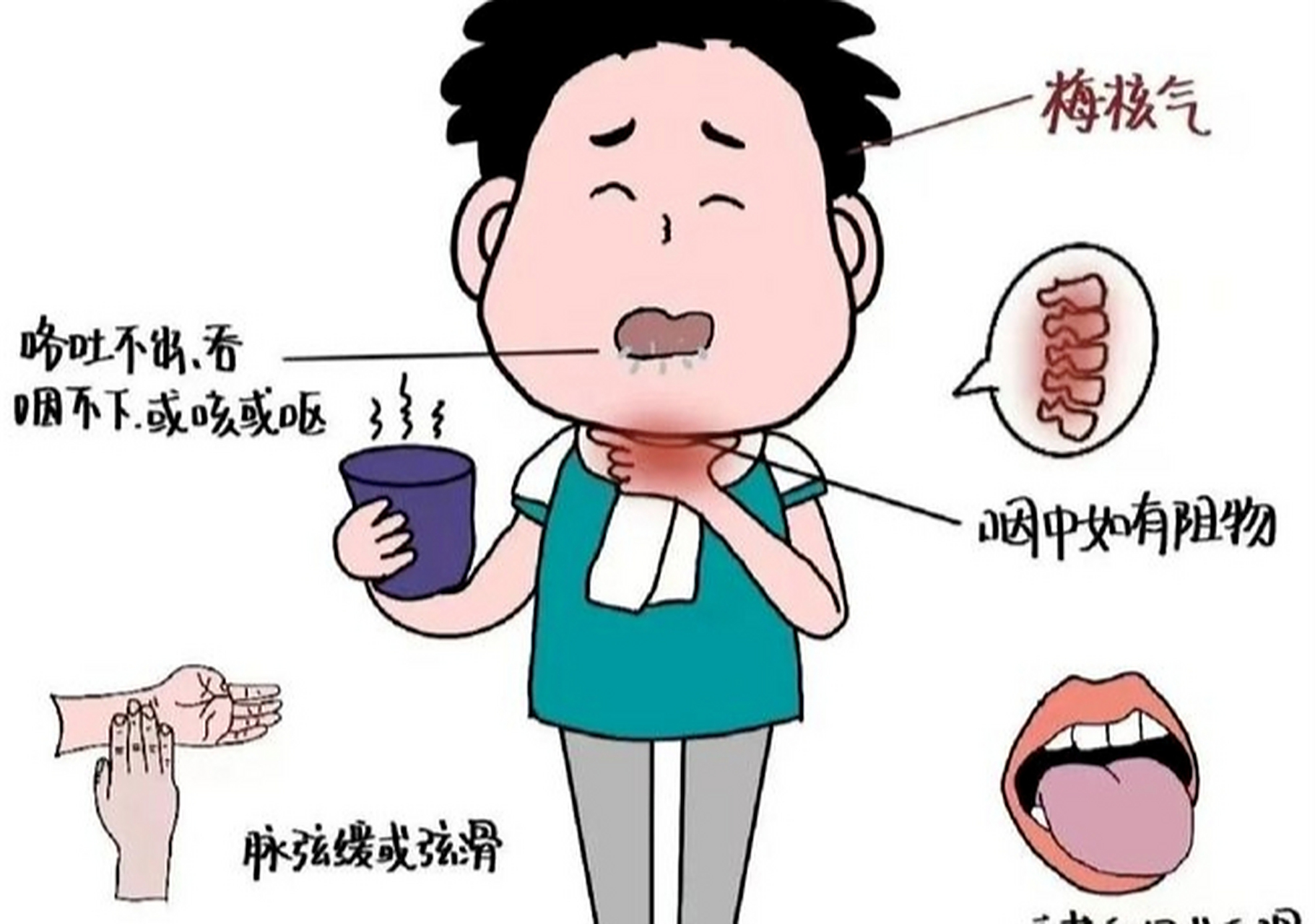 慢性咽喉炎,梅核气,医圣张仲景治咽第一方,行气散结,降逆化痰!