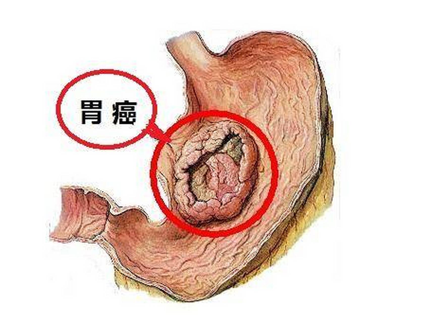 身体出现以下5种疼痛,警惕胃癌表现! 1.