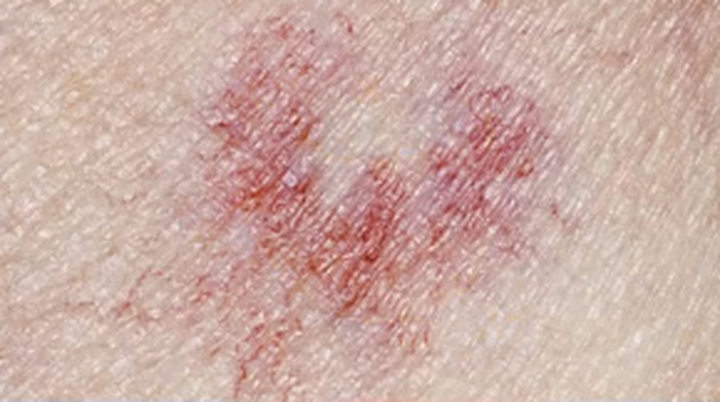 面诊时很多患者说自己长了蜘蛛痣,尤其是肝病患者,都不清楚蜘蛛痣到底