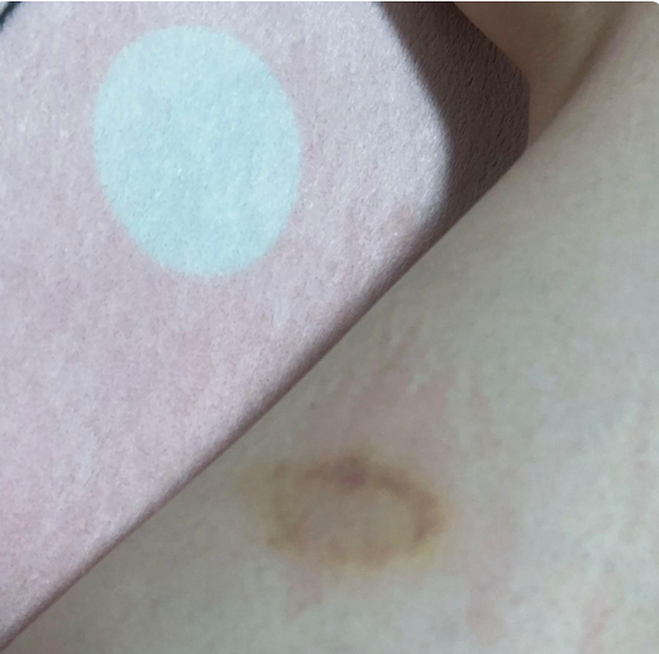 今天下班回来发现女朋友的腿上有一块淤青,她告诉我这是被蚊子咬的