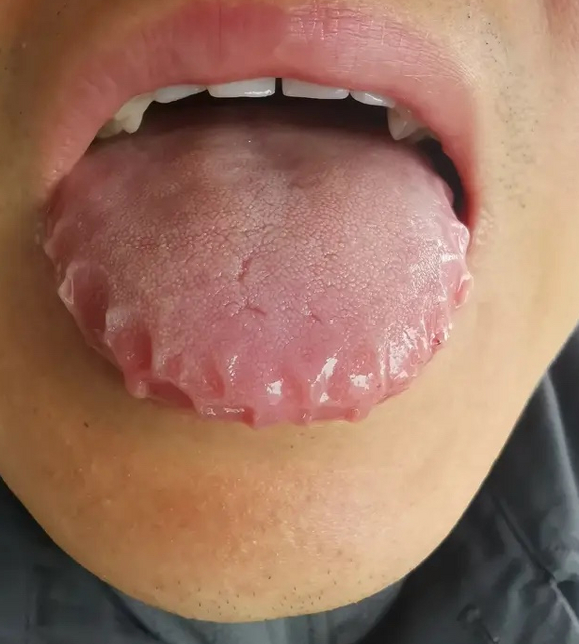 这齿痕舌的严重程度,已经远非简单的祛湿所能解决