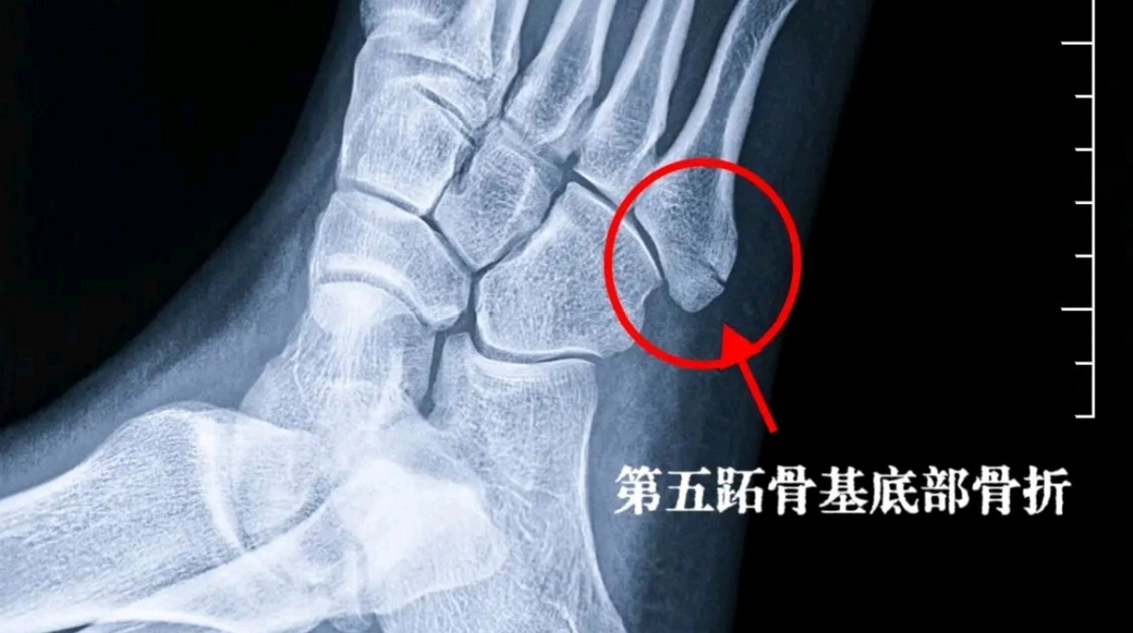 崴脚脖子后,别只盯着脚踝,第五跖骨基底这地方很容易漏诊!