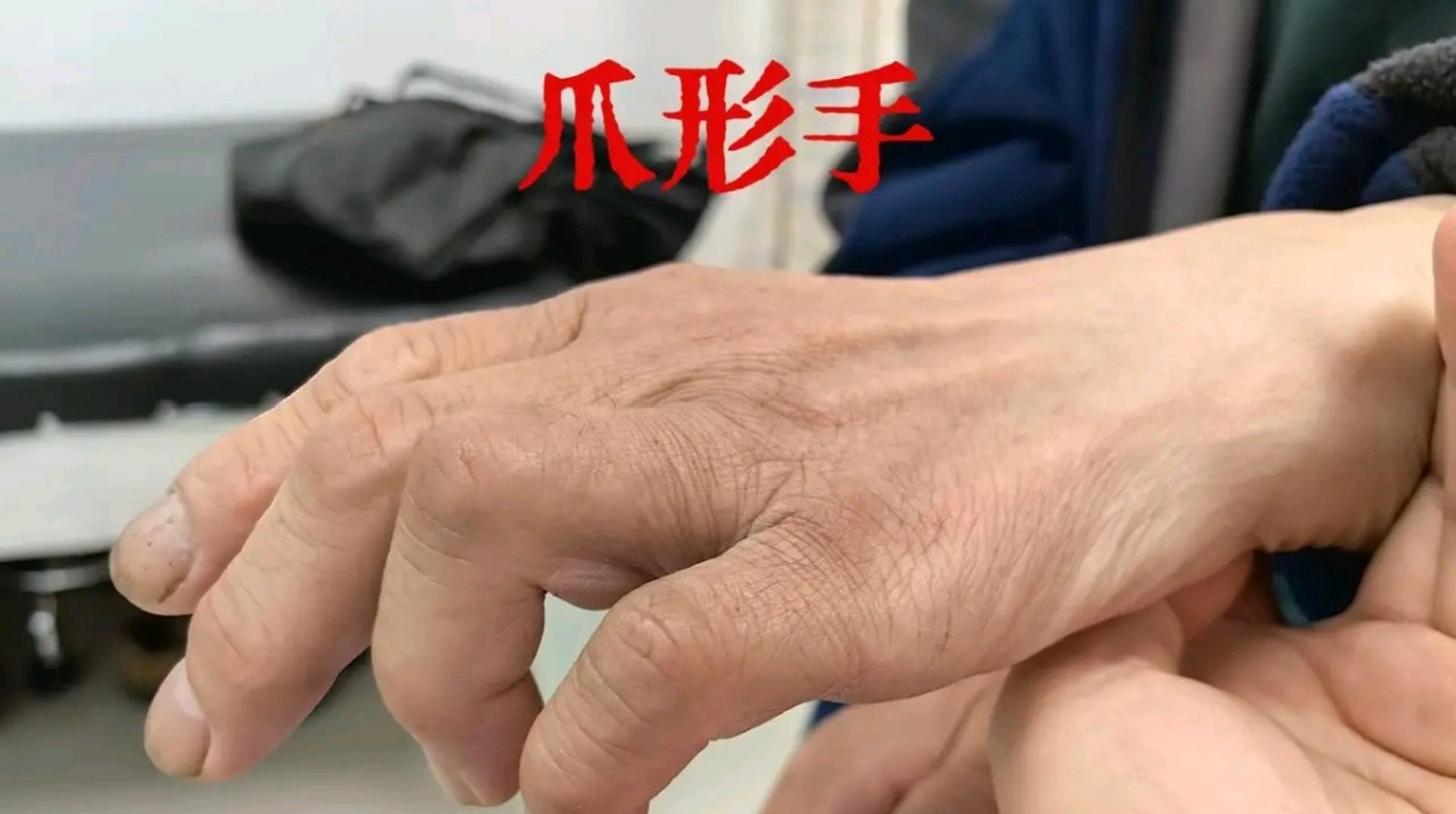 小指麻木别大意,不要等到功能障碍,形成"爪形手"再来就诊!