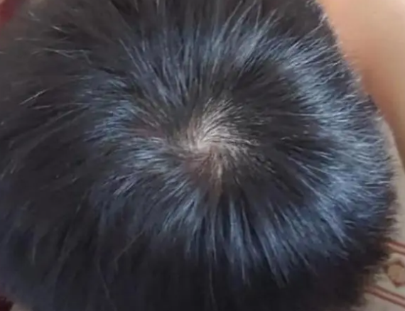孩子头上的“旋”代表什么?与智商和性格有关吗?今天科普真相