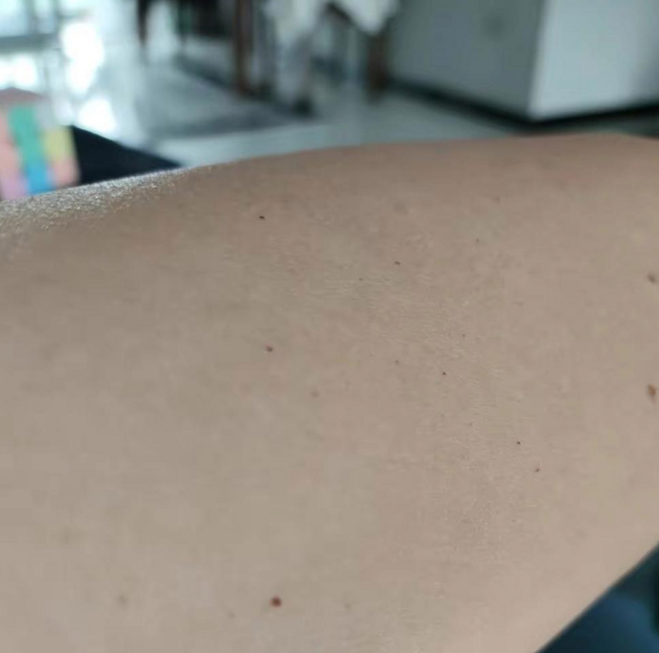 这手臂上长的黑色点点是什么?不会是老年斑吧?