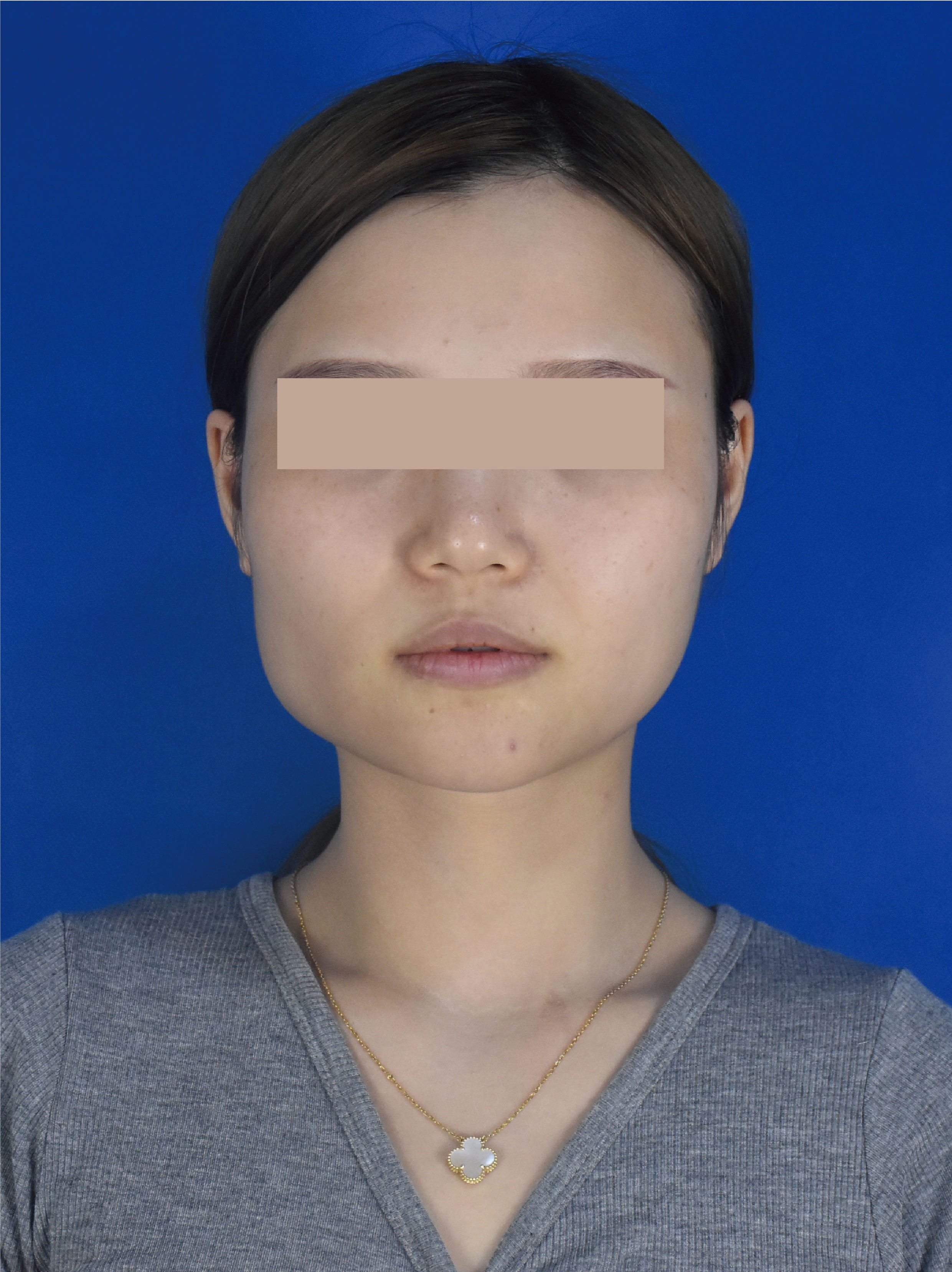 30岁因为大小脸很自卑不敢和别人对视拍照也是侧脸