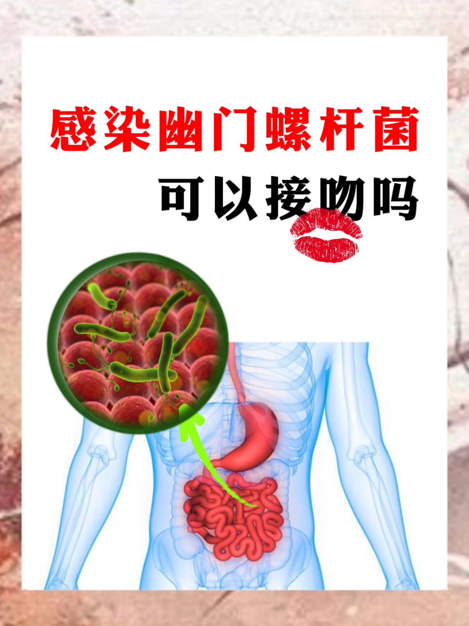 感染幽门螺旋杆菌可以接吻吗?#中医# #中医谈健康# #幽门螺杆菌