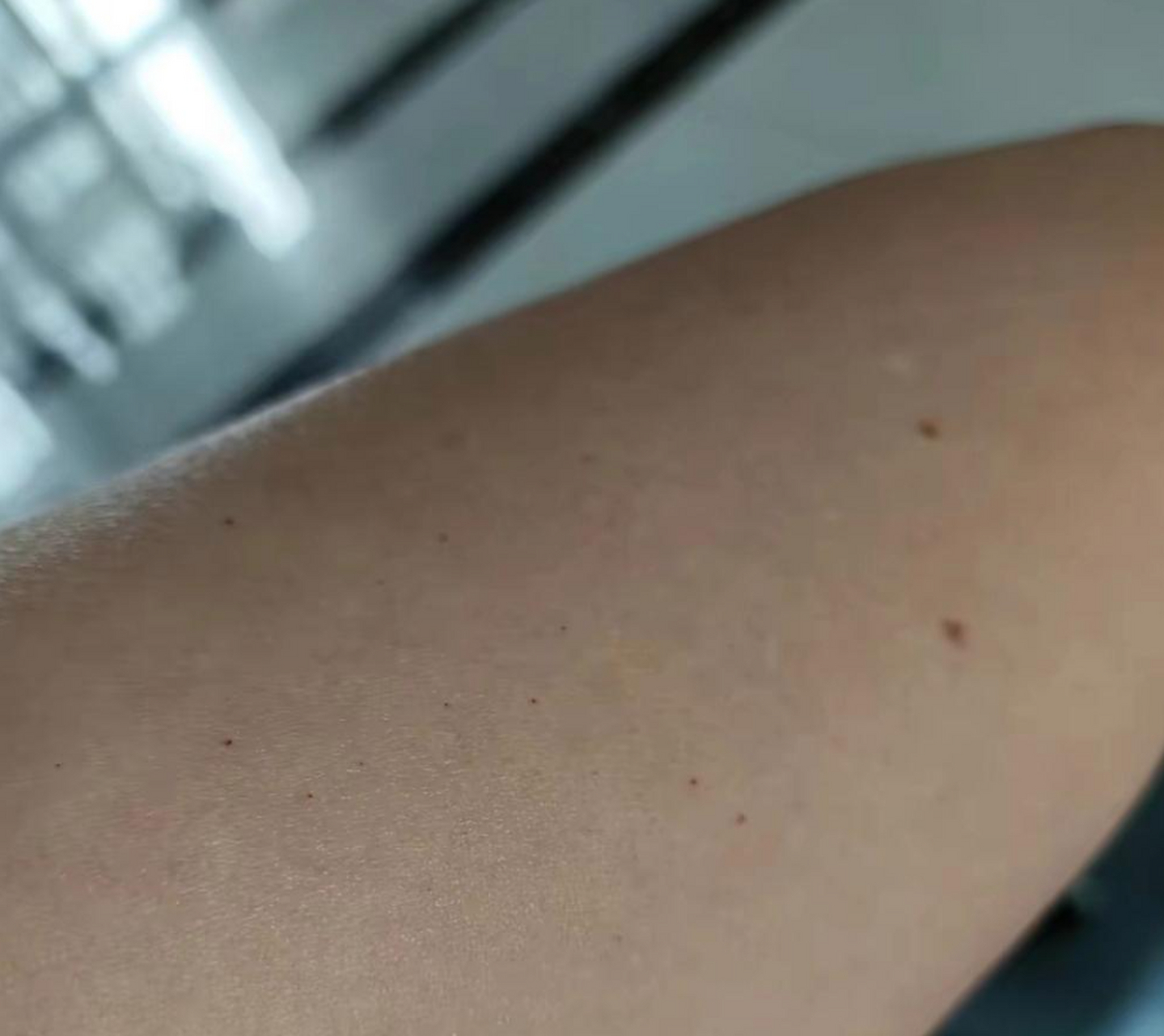 这手臂上长的黑色点点是什么?不会是老年斑吧?