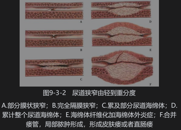 尿道狭窄诊疗指南