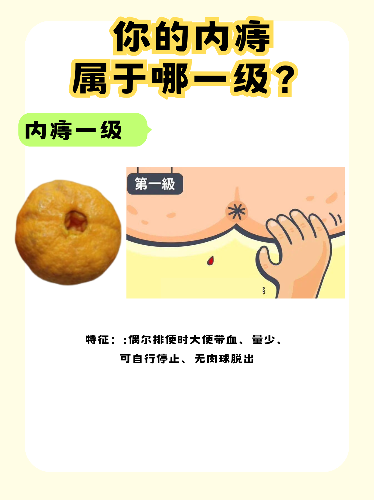 痔疮长什么样?赶紧来对照看看你是哪一类?