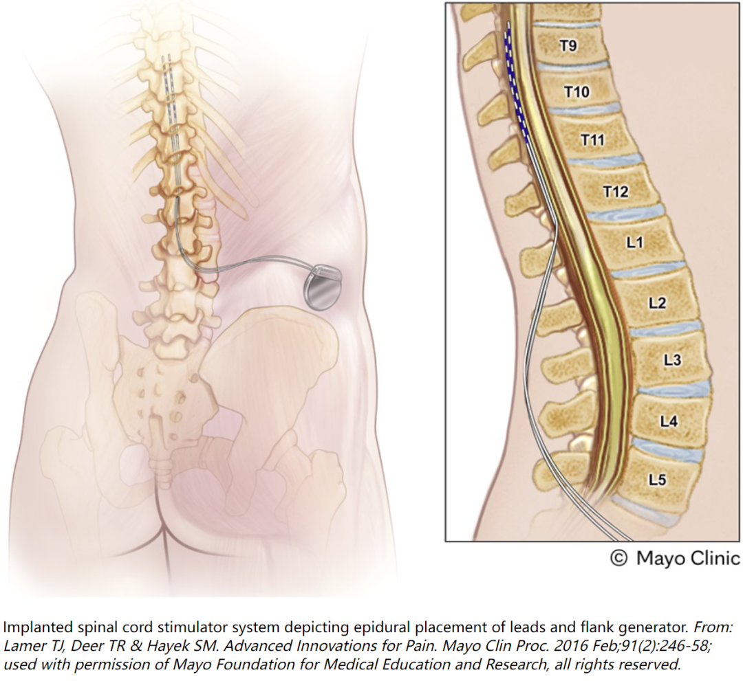 脊髓电刺激的发展历史和未来