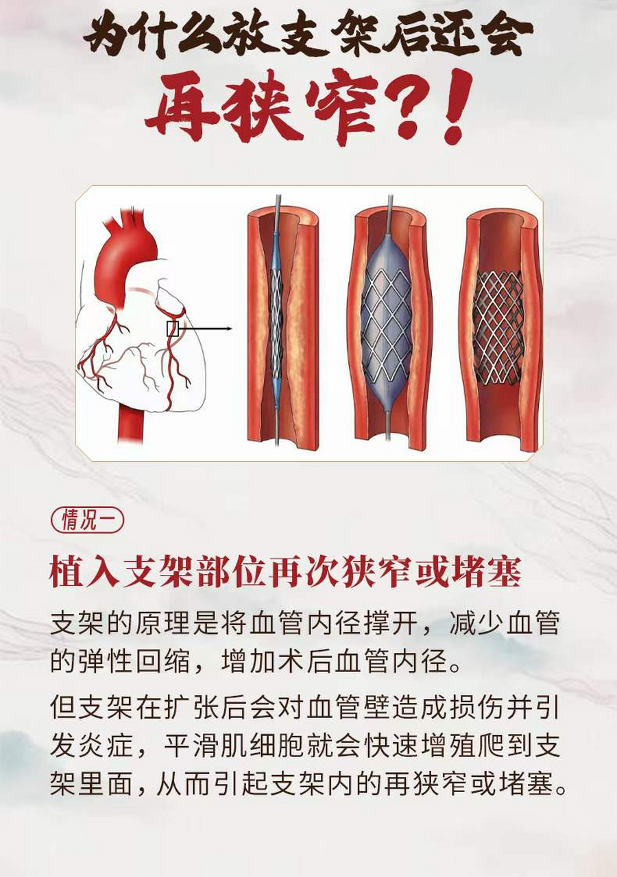 心脏支架位置图片