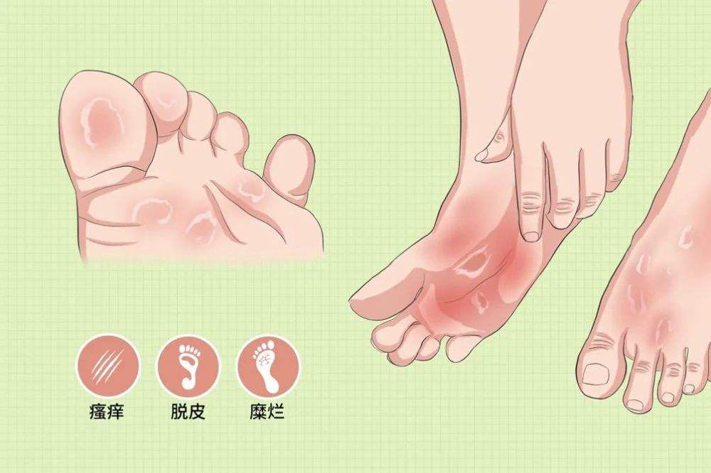 脚气,即足癣,是一种由真菌感染引起的皮肤病.