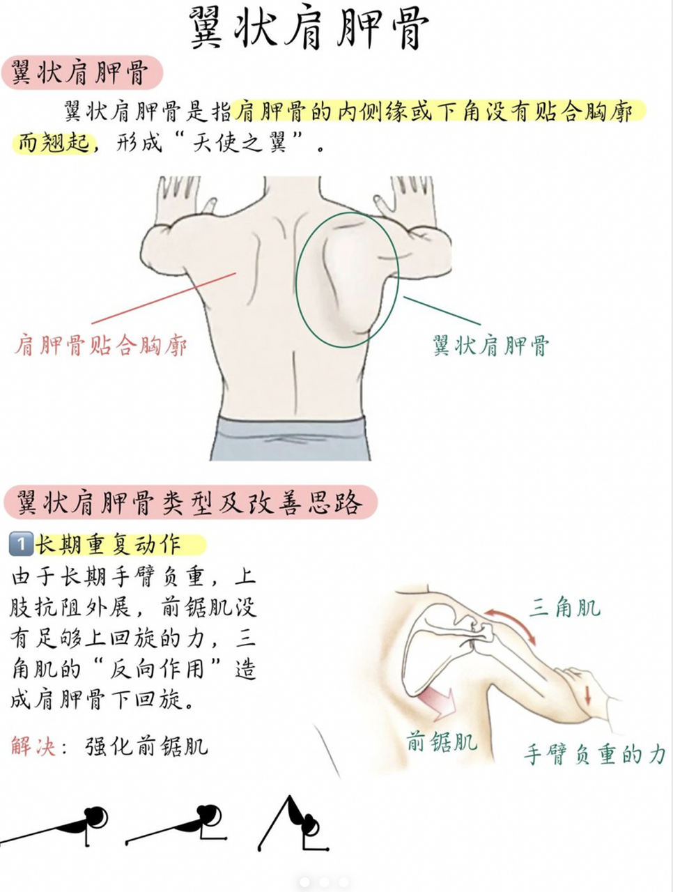 干货|翼状肩胛骨改善思路,看这一篇就够了6015 翼状肩胛骨又被称