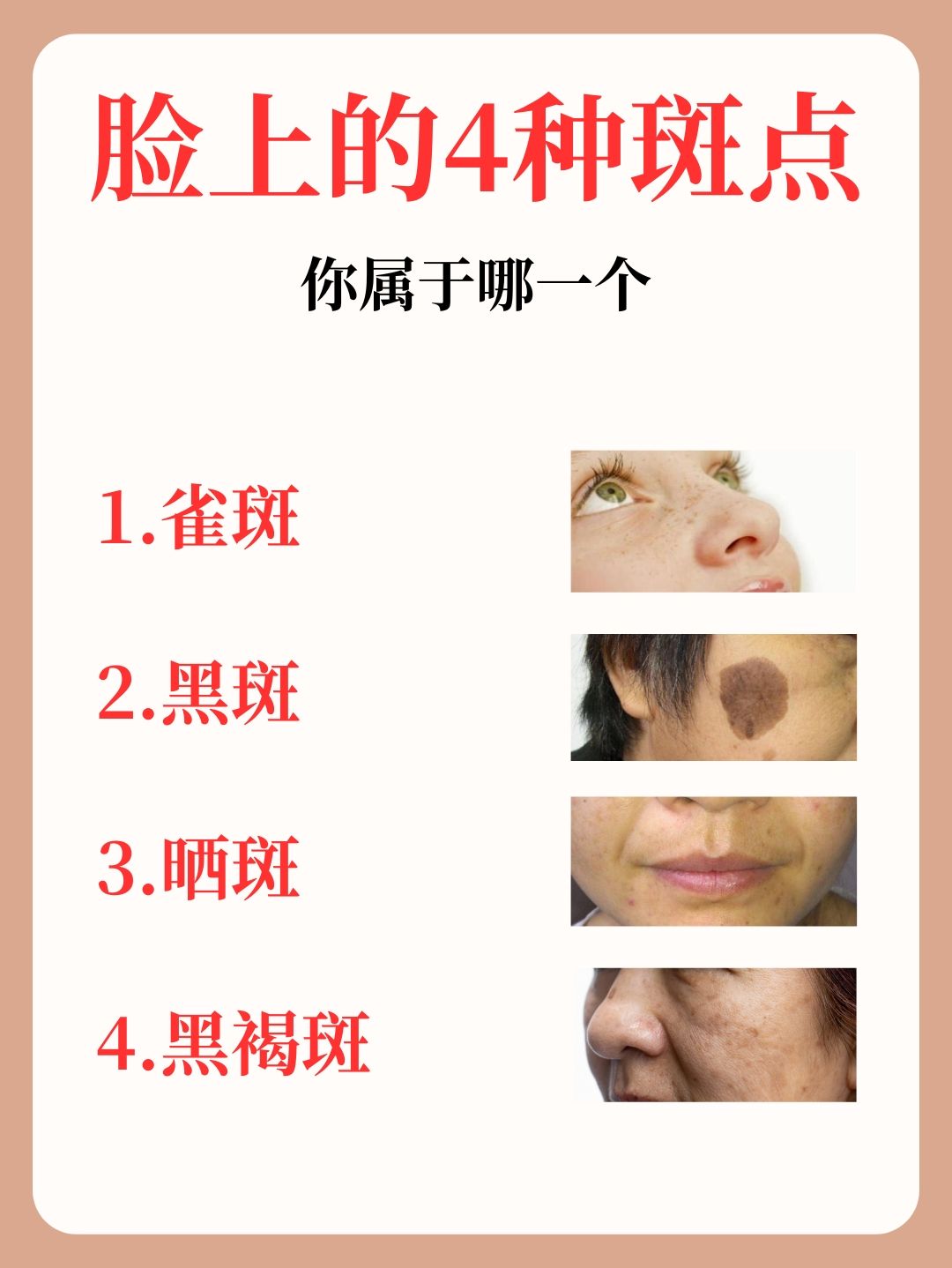脸上斑点分为4种,你的是哪一个?