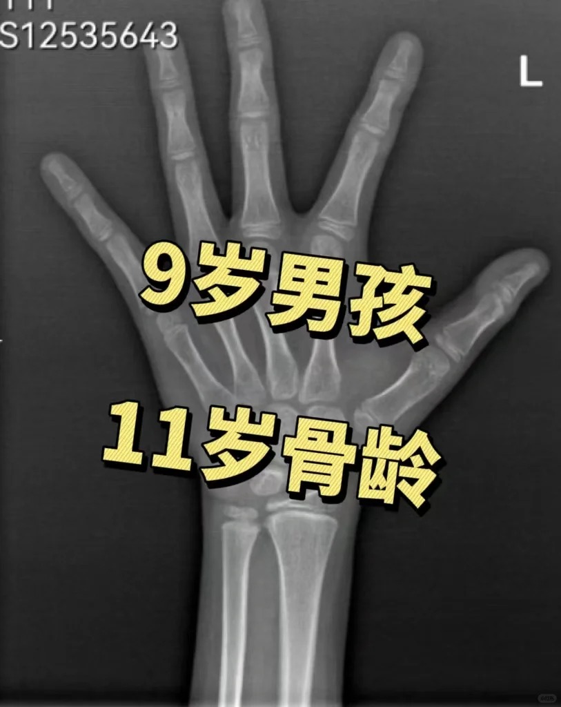 这个年纪应该还没发育澳泻 骨龄对照图男孩骨龄图谱男孩各年龄段骨龄